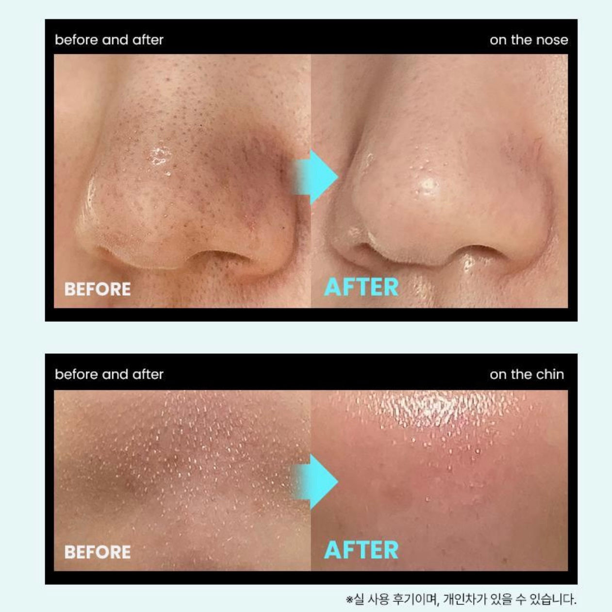 ilso 150ml+150ml 黑頭粉刺導出液🥚