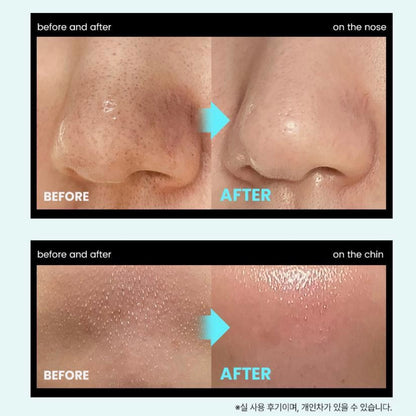 ilso 150ml+150ml 黑頭粉刺導出液🥚