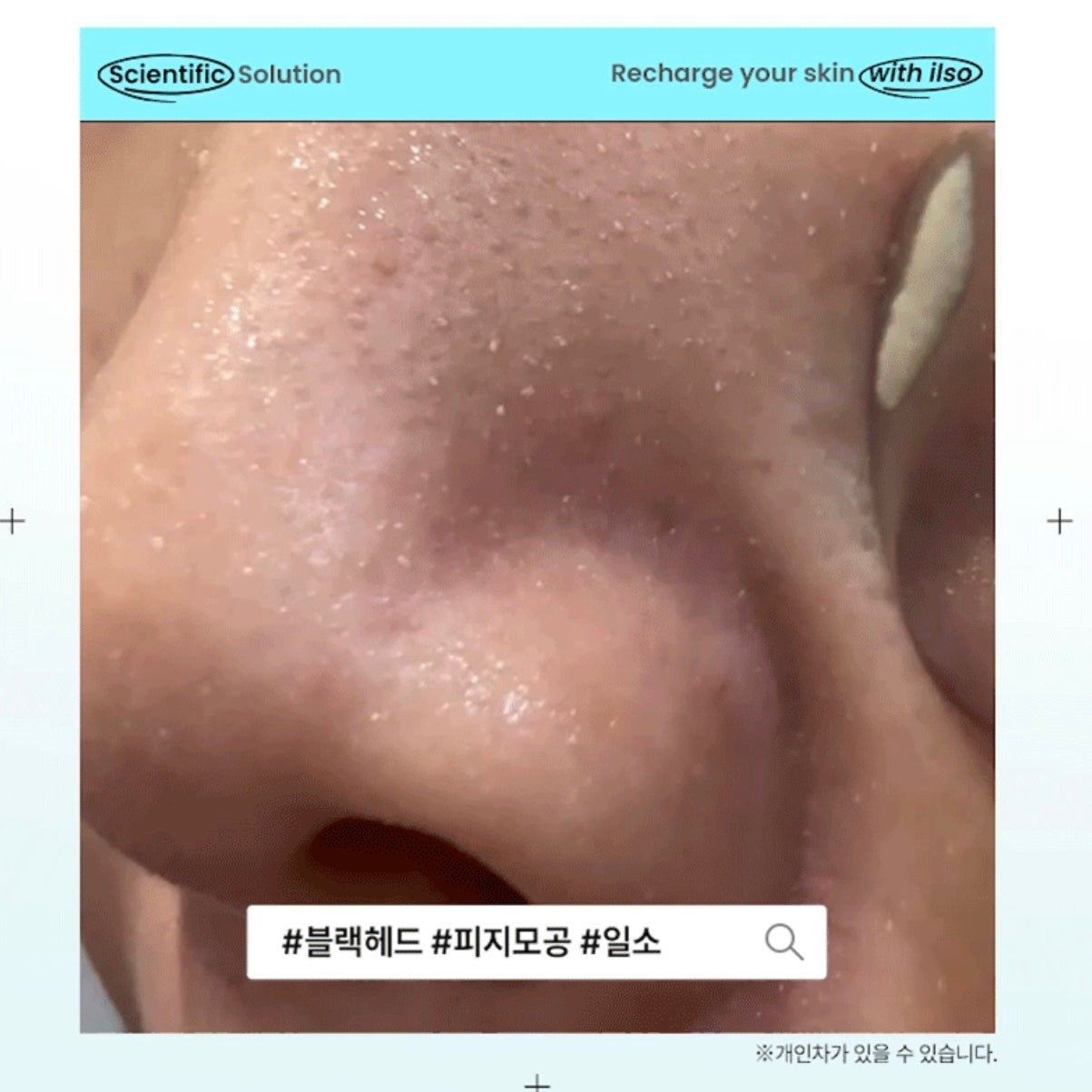 ilso 150ml+150ml 黑頭粉刺導出液🥚